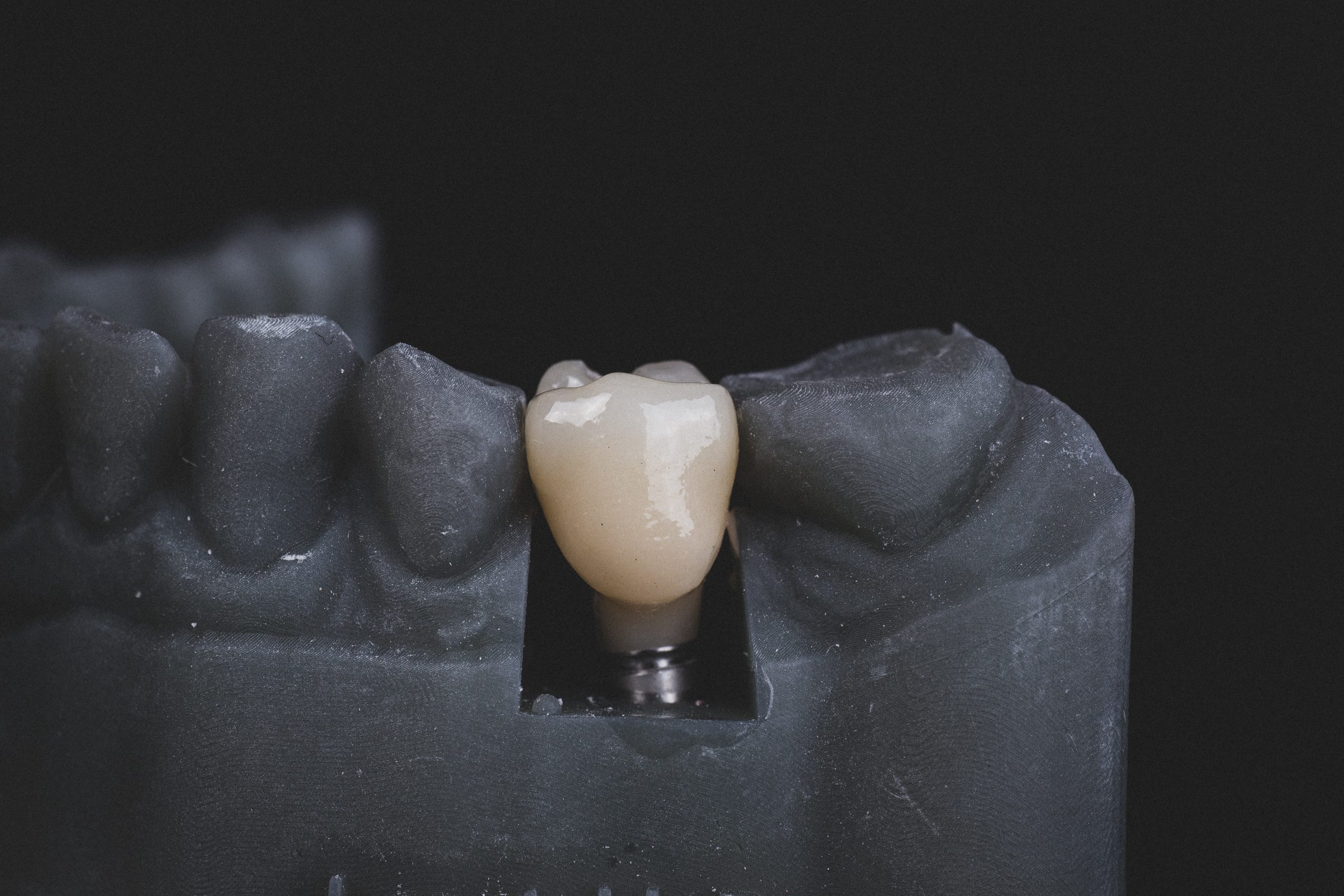 Why Dental Implants Are the Gold Standard for Tooth Replacement: Insights from Arch Dental in Tracy, CA