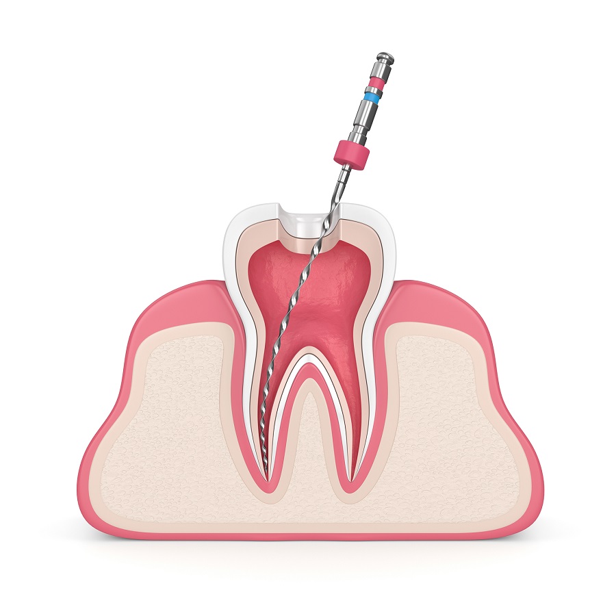 Key benefits of a Root Canal Treatment