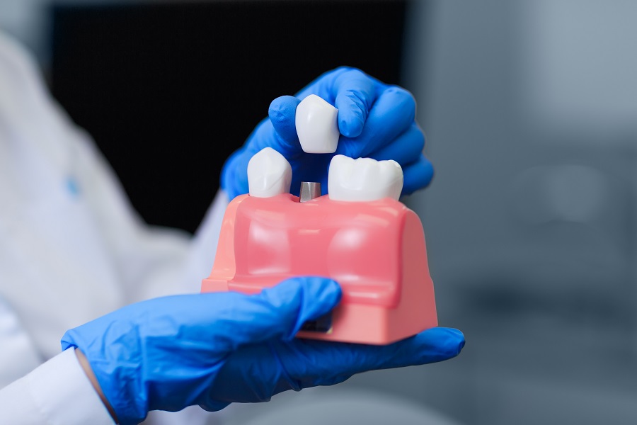 Dental Implants: Everything You Need to Know Before Undergoing the Procedure