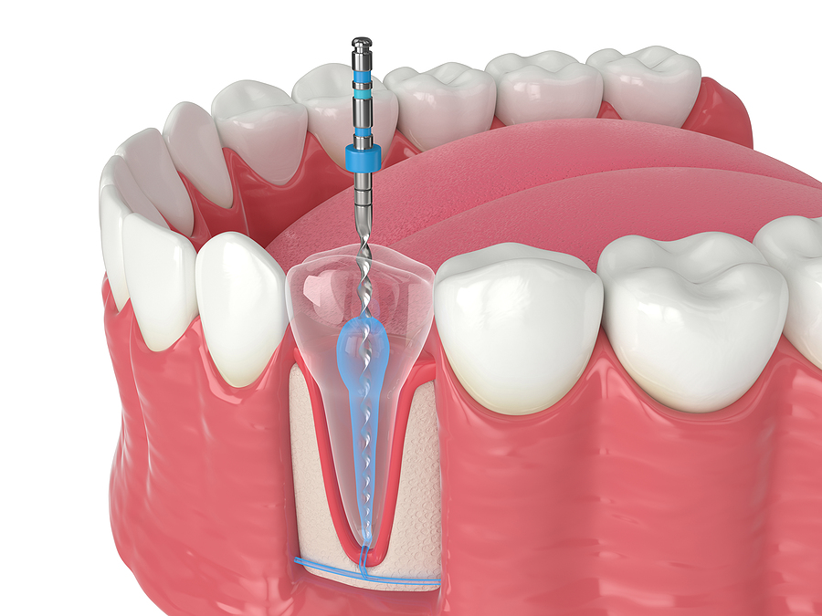 A Comprehensive Guide to Endodontics in Tracy, CA